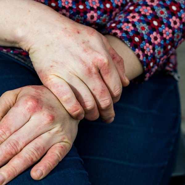 Dishidrotični ekcem: Ovaj tihi kožni poremećaj pogađa sve više ljudi – prepoznajte simptome na vrijeme!