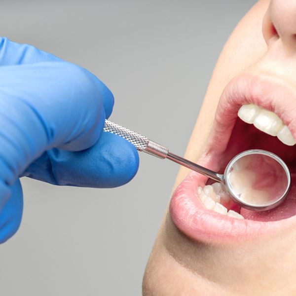 Kraj karijesa i plombi? Revolucionarni gel obnavlja zubnu caklinu