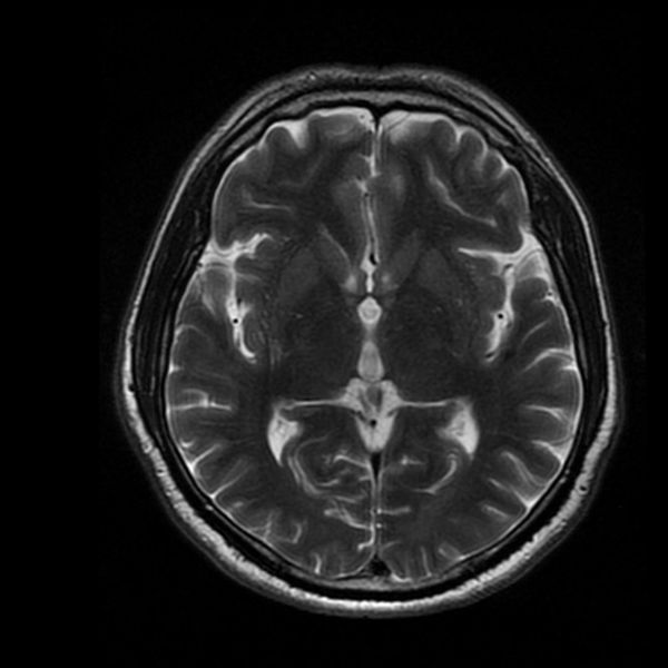 Otkrivena skrivena kombinacija koja ubrzava starenje mozga i povećava rizik od Alzheimerove bolesti