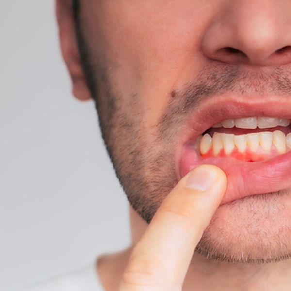 Nevjerojatno otkriće: Uzročnik raka dojke mogao bi se skrivati u ustima