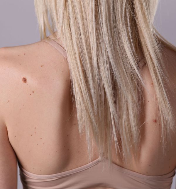 Iako je većina madeža na tijelu bezopasna i benigna, neki mogu biti poprilično opasni