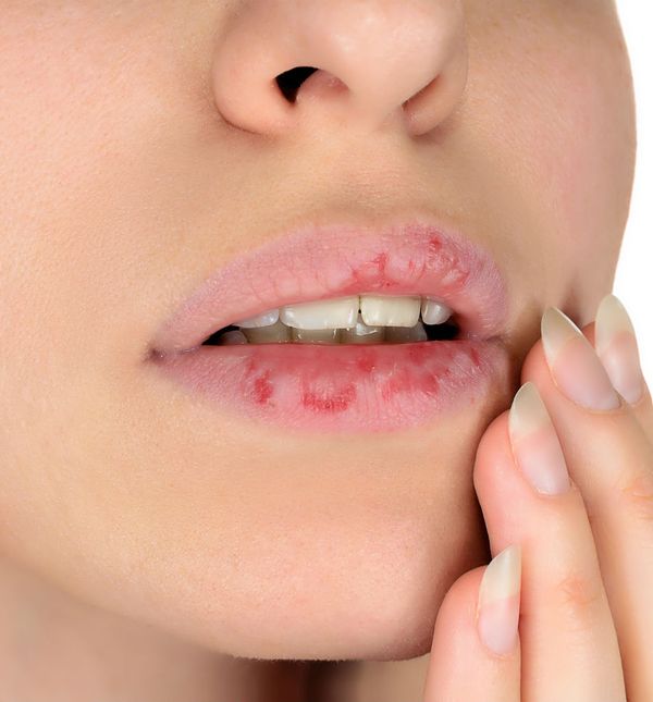 Ispucale usnice mogu značiti da je vaš organizam preopterećen