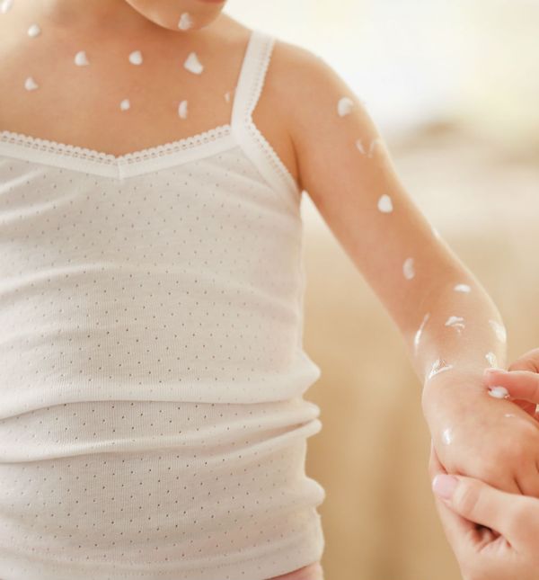 Vodene kozice vrlo su zarazna bolest, ali u većini slučajeva prođe bez komplikacija