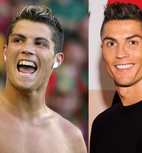 Cristiano Ronaldo prije i nakon što je sredio zube