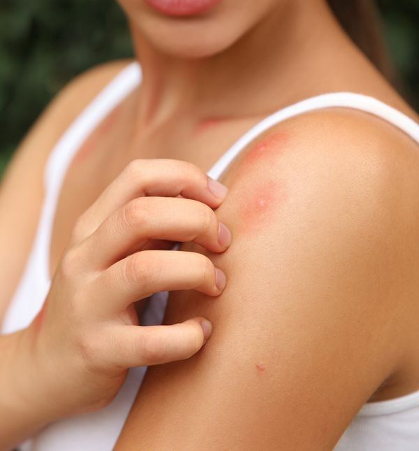 Ubod komarca jako svrbi i iritira