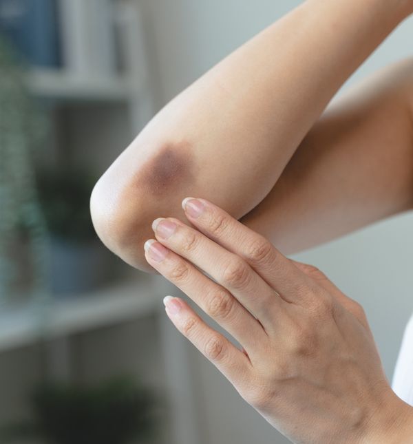 Lako stvaranje modrica može upućivati na nedostatak vitamina K