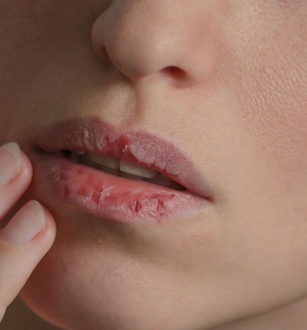 Suhe usne su čest problem zimi