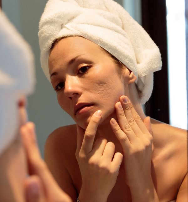 Akne nakon puberteta