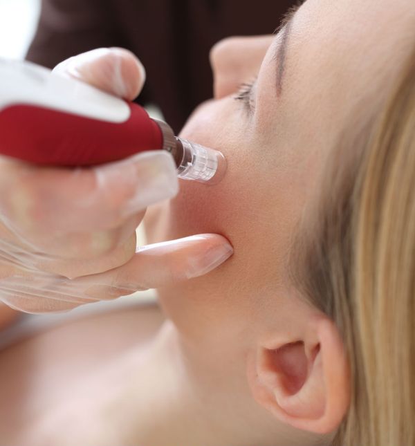 Mezoterapija je popularna metoda za pomlađivanje kože