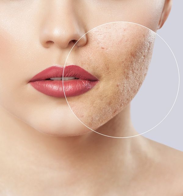 Kako riješiti akne u odrasloj dobi