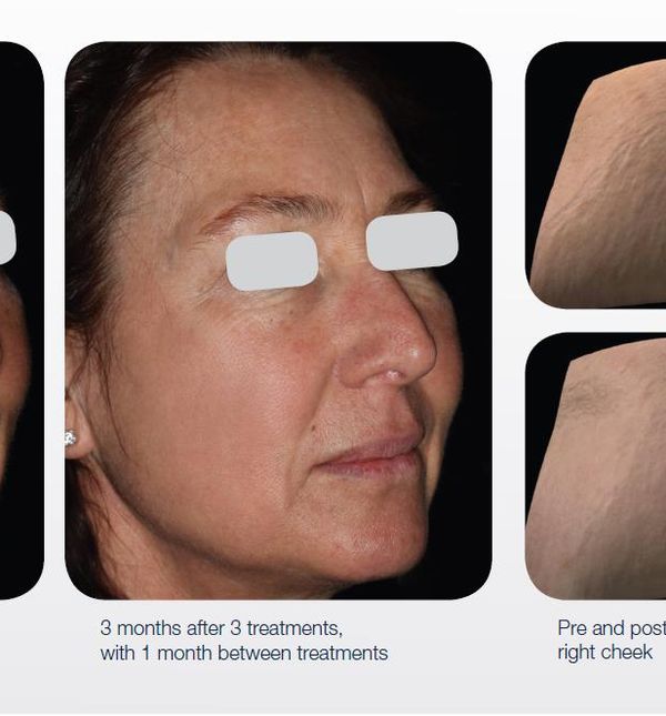 Prije i poslije tretmana laserom LUMENIS M22