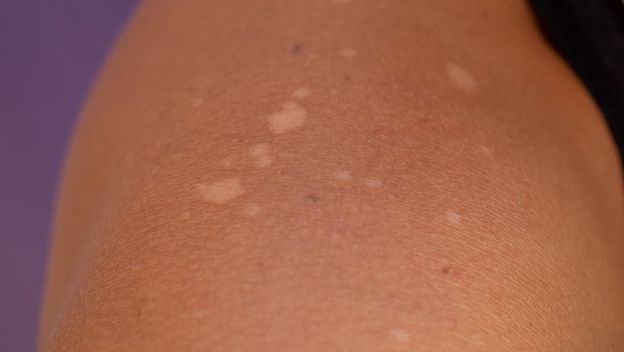 Bijele mrlje na koži: Znak bezazlenog problema ili ozbiljne bolesti?