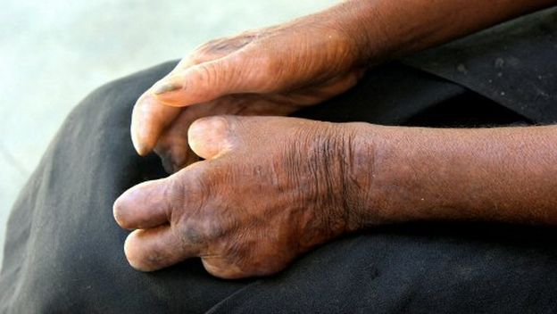 Ruke pacijenta oboljelog od gube