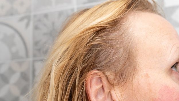 Primjećujete prorjeđivanje kose? Krivac bi mogao biti vaš lijek za artritis!