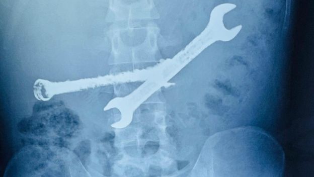 Progutao četkice i ključeve