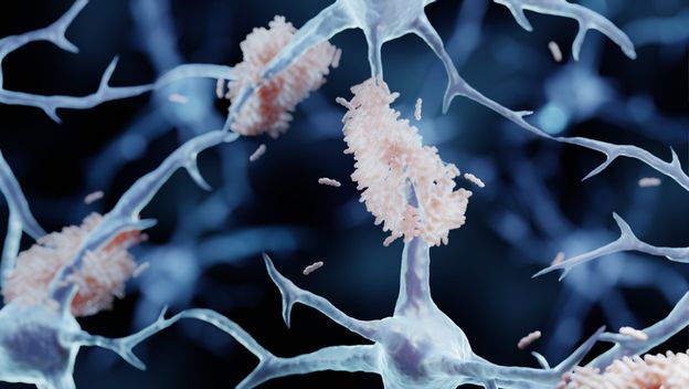 Amiloidni plakovi na neuronima u mozgu, ilustracija