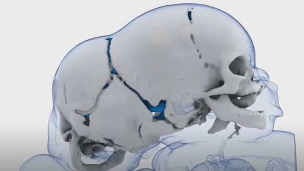 Razdvojene sijamske blizanke - 2