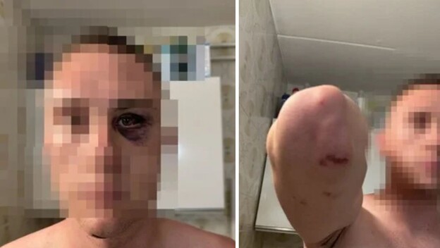 Slovenski državljanin napadnut u Medulinu