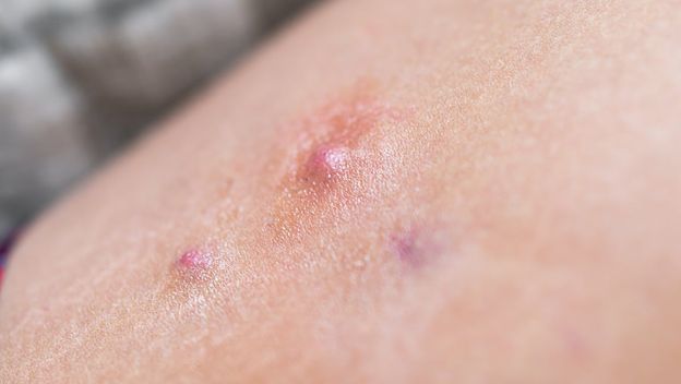 Čirevi na preponama: Mnogi ih zamijene za uraslu dlaku, a posljedice mogu biti ozbiljne