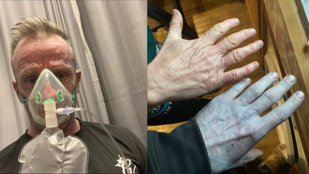 Tommy Lynch i njegovo bizarno plavo stanje