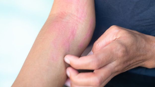 Ako vam se koprivnjača stalno vraća, moguće je da imate ovo stanje kože!