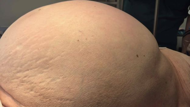 Odstranjen tumor težak 36 kilograma