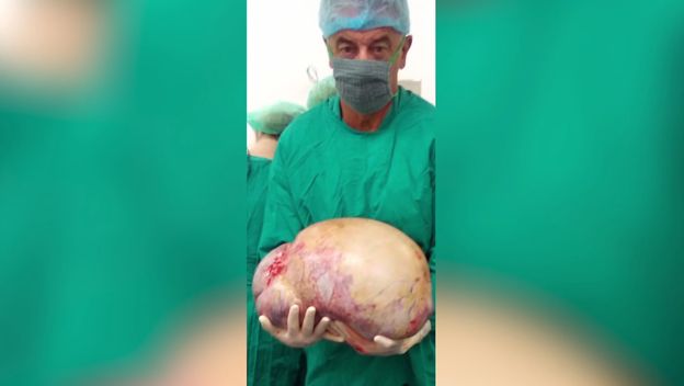 Uklonjen najveći tumor u Hrvatskoj