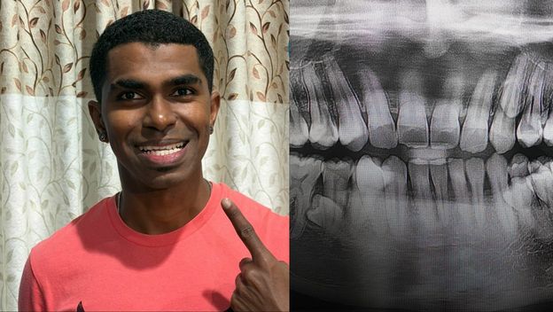 Muškarac iz Malezije Prathab Muniandy i njegovi rekordni zubi