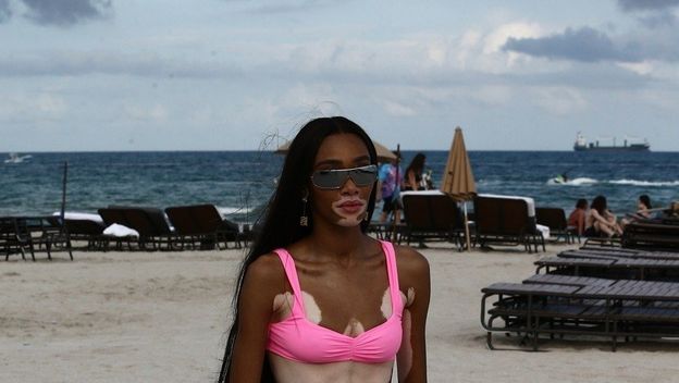 Winnie Harlow (Foto: profimedia)