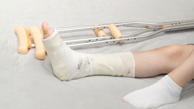 Noga u gipsu i štake pored osobe koja leži na krevetu