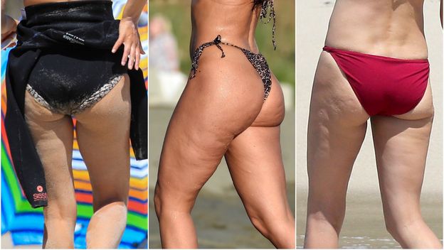 Celulit imaju i najljepše žene svijeta