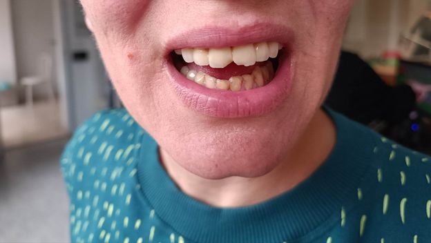 Mariji Laptalo na gastroskopiji oštetili zube