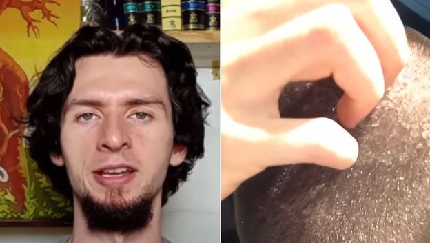 Youtuber Aidan i njegov skalp prije i nakon odricanja šampona