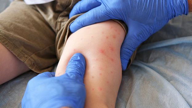 Ospice kod djece; Ilustracija