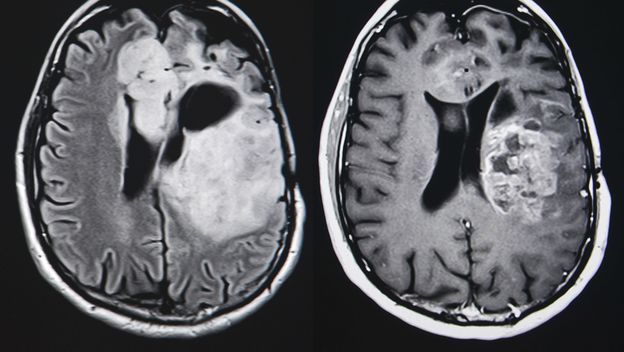 Tumor na mozgu, ilustracija