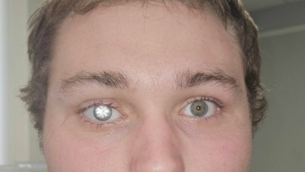 Slater Jones i njegovo proteza za oko s dijamantom