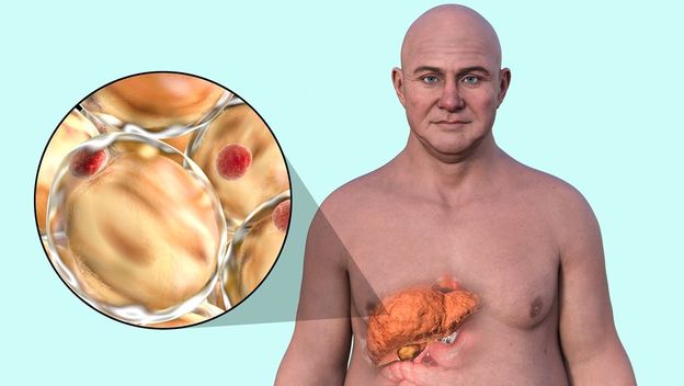 2 uobičajena lijeka za srce mogu pomoći u preokretanju masne bolesti jetre?