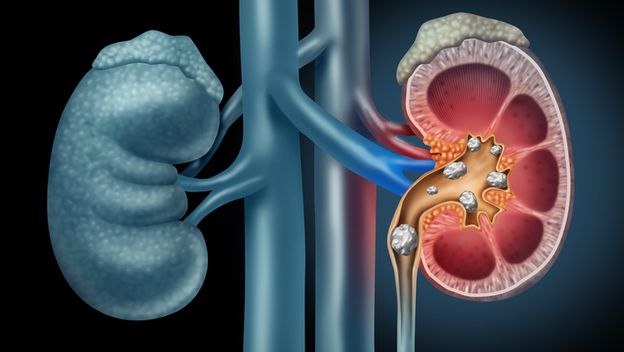 Bubrežni kamenci, ilustracija