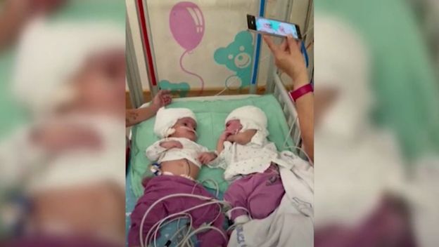 Razdvojene sijamske blizanke - 5