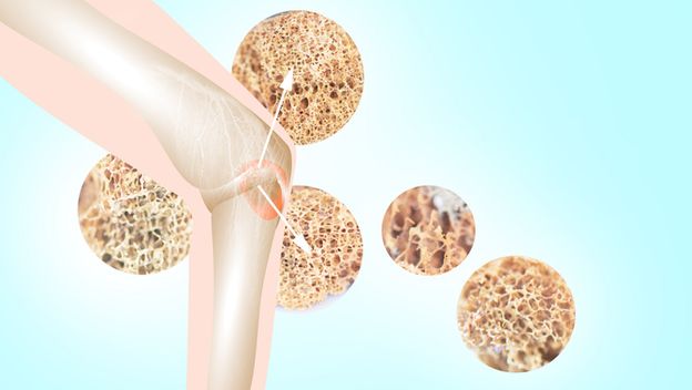 Osteoporoza, ilustracija