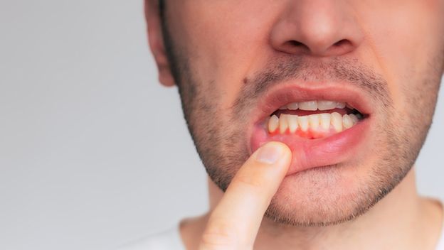 Upaljene desni, ilustracija