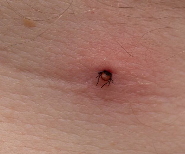 Bolesti od krpelja: Ovi simptomi znače da morate odmah liječniku