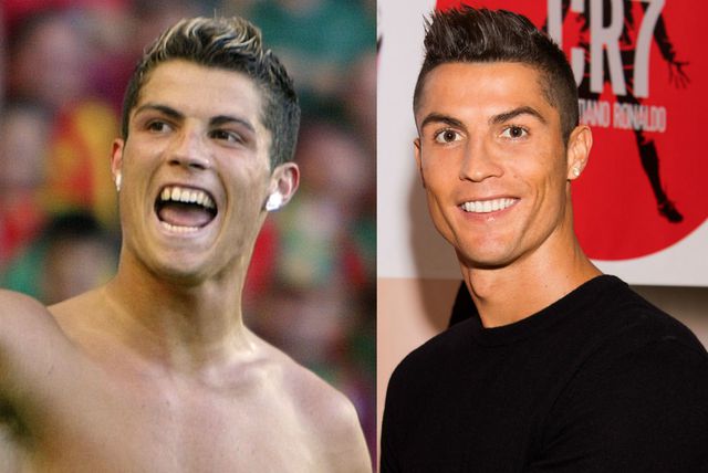 Cristiano Ronaldo prije i nakon što je sredio zube