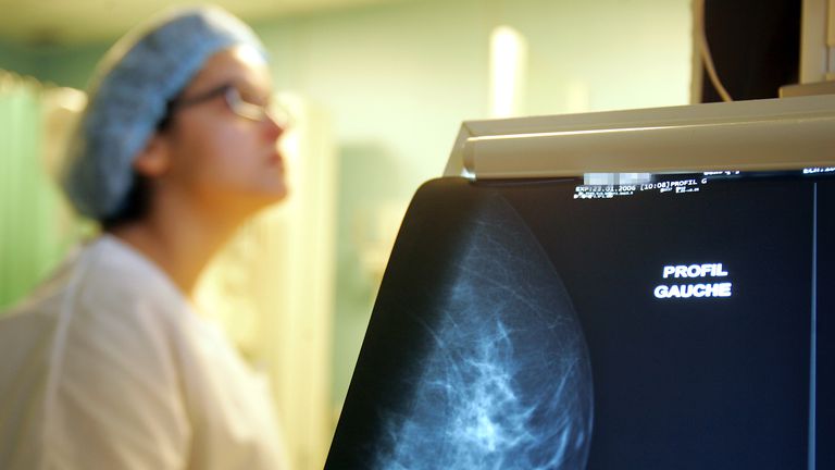 Mamogram (Foto: AFP)