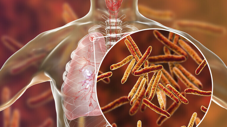 Tuberkuloza, ilustracija