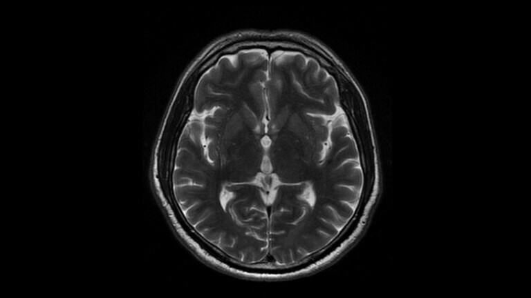 MRI mozga, ilustracija