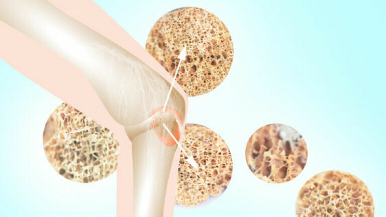 Osteoporoza, ilustracija