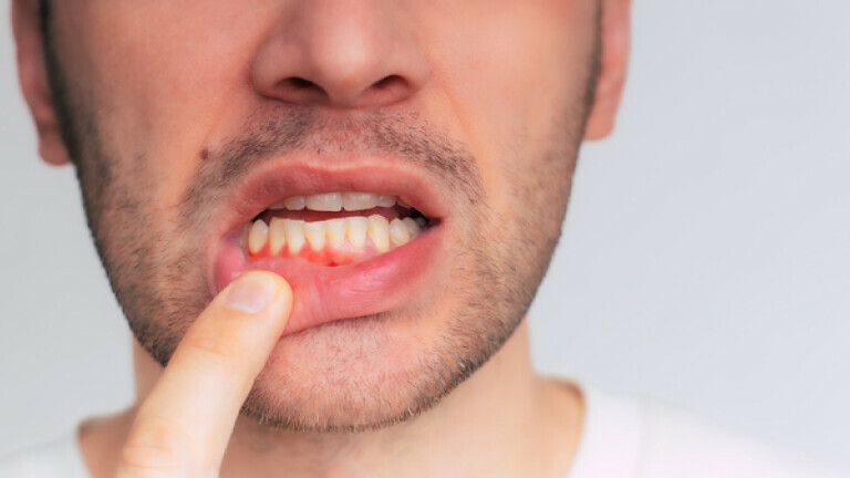 Upaljene desni, ilustracija