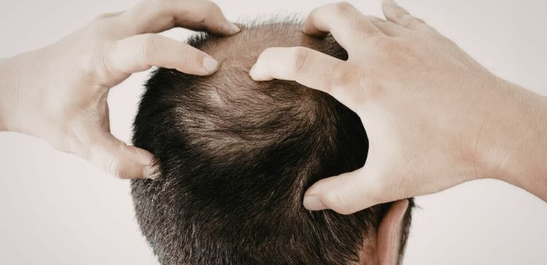 Ćelavi muškarac s rukama na glavi