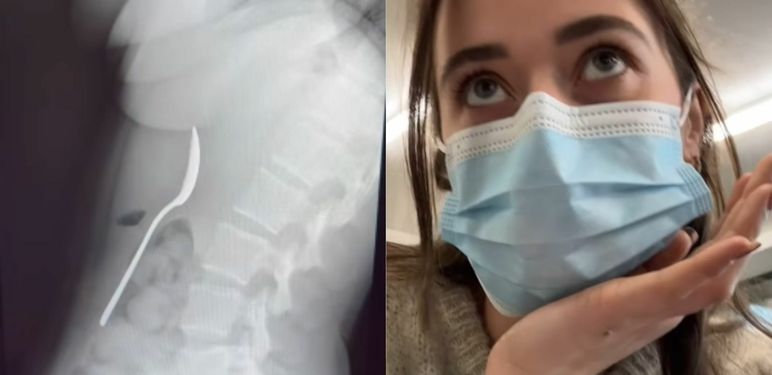 Belgijka sa žlicom u želucu